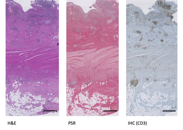 Examples of stained Crohn’s Diseased Ileum (Scale bar = 1000 µm)