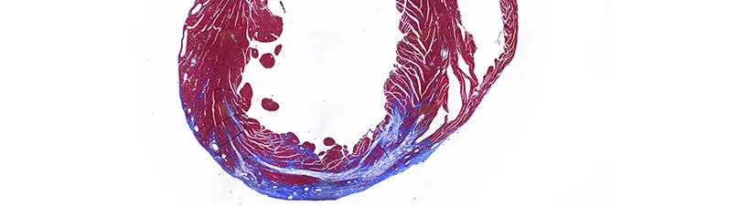 Cardiac infarct (Masson's stain)