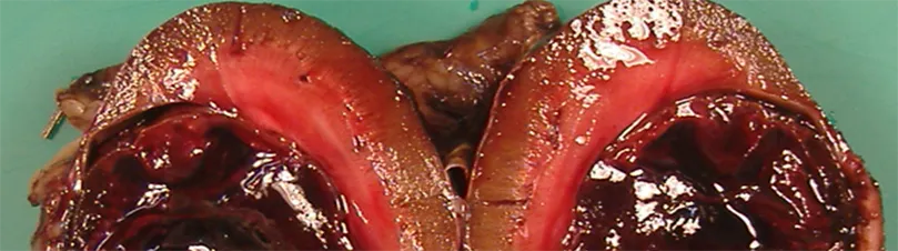 Renal Haemangiosarcoma
