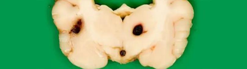 Metastatic haemangiosarcoma