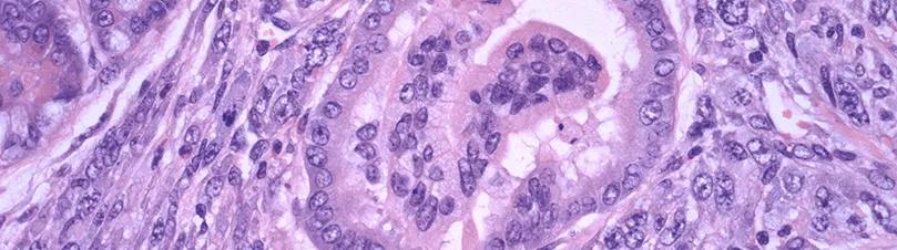 Pancreatic Intraepithelial Neoplasia (mouse)